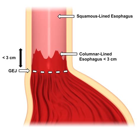 picture of gastroesophageal junction